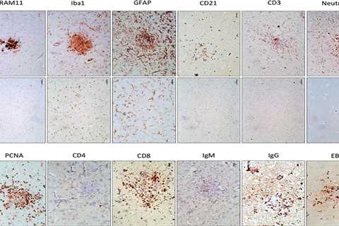 DoctorBunny…Is EBV the target in MS?