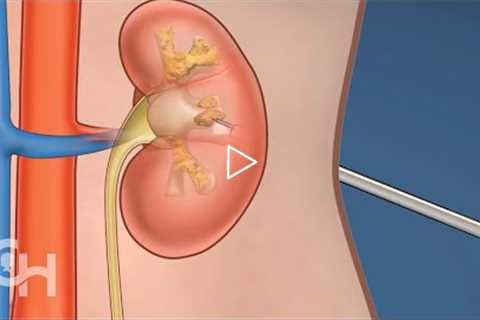 Percutaneous Nephrolithotomy (PCNL) for Kidney Stones in Children