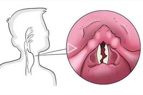 The 4 Underlying Causes of a Hoarse Voice