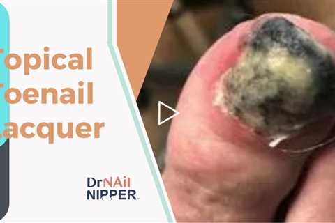 Patient used topical toenail lacquer.  Callus Tuesday on a Wednesday (2022)