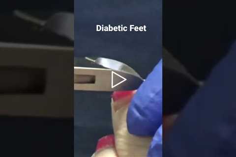 Diabetic Feet with Dr Nail Nipper.