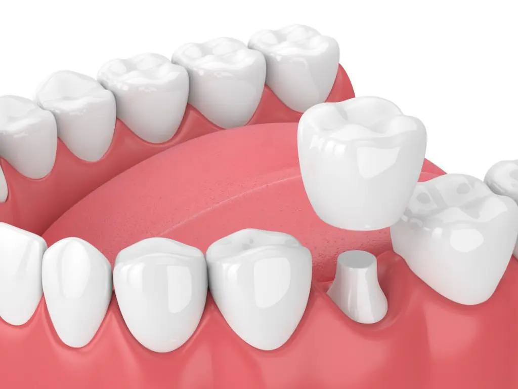 What Are Zirconia Crowns? – kidodent