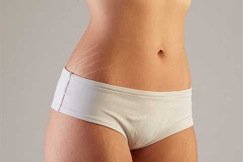 Is a Tummy Tuck Right for Me?