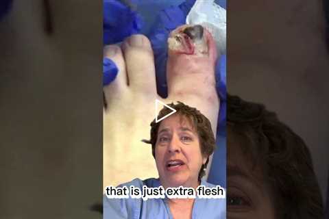 Courtney's Total Avulsion