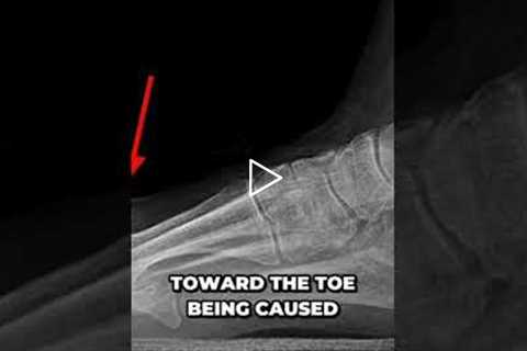 Shocking Arthritis Cyst Uncovered on Big Toe Joint @DrNailNipper