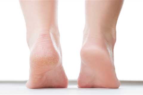 Flexitol Heel Balm Is Saving Dry, Cracked, Callused Feet