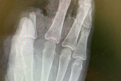 A 15-year-old was moderately injured by a refinery explosion and his finger was amputated – •