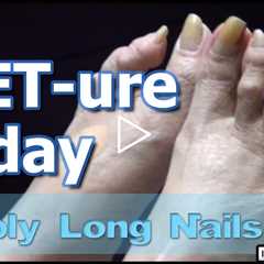 Long Toenails | FEET-ure Friday - Dr Nail Nipper (2024)