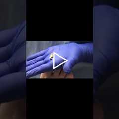 Witness the fascinating process of transforming a ram's horn nail!   #PodiatryMagic #HealthTips