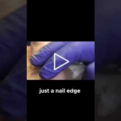 Curious about nail removal recovery? #NailCare #RecoveryJourney #HealthTips