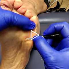 Massive Callus Cleanup by Dr. Nail Nipper | Real Patient Foot Health - Patient 1
