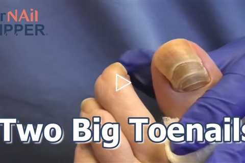 Two Big Toenails #Toenails #foothealth #podiatrycare