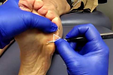 Massive Callus Cleanup by Dr. Nail Nipper | Real Patient Foot Health - Patient 1