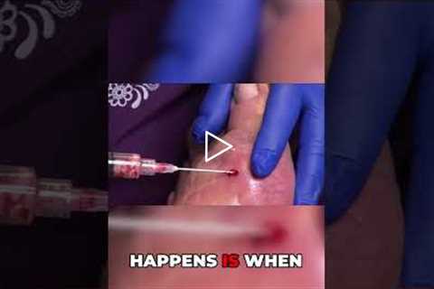 The Connection Between Temperature and Gout Crystals