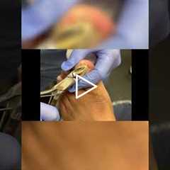 Managing Nail Growth and Comfort 🦶