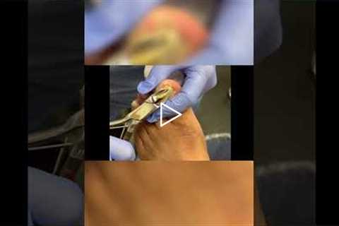 Managing Nail Growth and Comfort 🦶