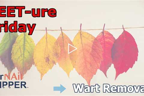 FEET-ure Friday | Wart Removal