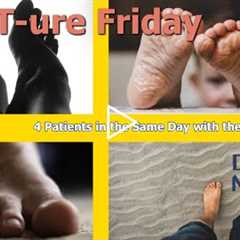 FEET-ure Friday | 4 Patients in the Same Day with the Same Callus!! 👣🔥