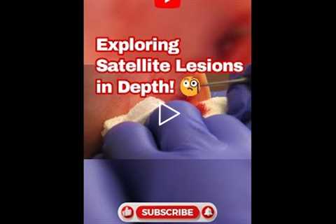 Exploring Satellite Lesions in Depth! 🧐