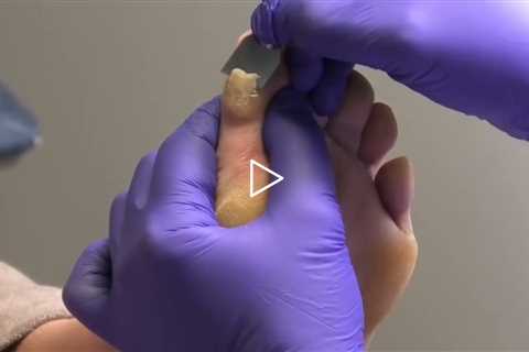 Why These Calluses Come Back Every 6 Weeks 🦶🧬 #CallusCare #FootCare #Podiatry