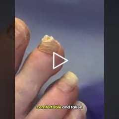 Podiatrist Shows Toenail Trimming Technique #satisfying #nailtreatment