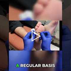 Open Wound & Callus - Do I Need a Doctor? 👣 | Foot Health, Infection Risk, Podiatry