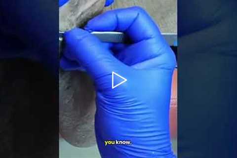 Did this callus suddenly become painful? 👣 | The Most Painful Part of a Podiatrist's Job