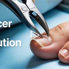 Pincer Toenails Explained | Why These Nails Hurt & How We Treat Them – Dr Nail Nipper