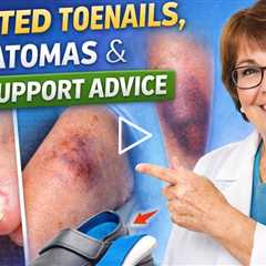Infected Toenails, Hematomas & Foot Support Advice | Dr Nail Nipper (Video from 2022)