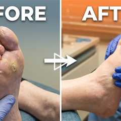 Severe Callus Relief — Watch the Transformation | The Bigger Callus was Less Painful