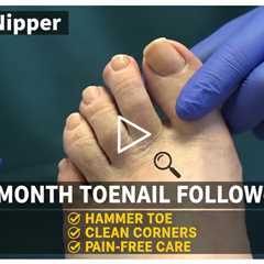 3-Month Toenail Follow-Up: Hammer Toe, Corners, and Pain-Free Foot Care
