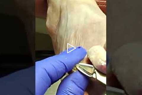 How a Podiatrist Removes Deeply Ingrown Toenails