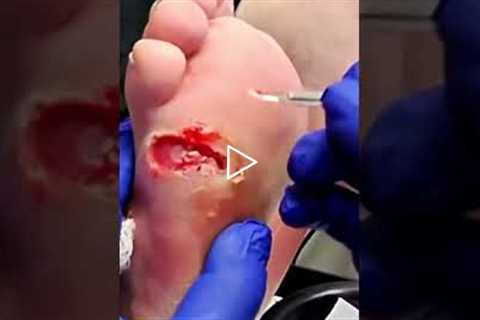 Wound Care Tips for At-Home Treatment 🩹👣