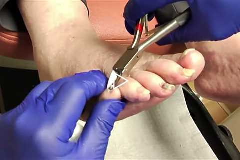 Routine Nail Trim With a Surprise Concern Between the Toes