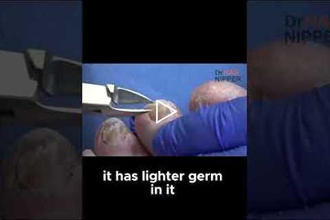 Discover the Secret Lotion That Eases Toenail