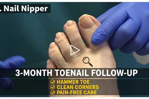 3-Month Toenail Follow-Up: Hammer Toe, Corners, and Pain-Free Foot Care