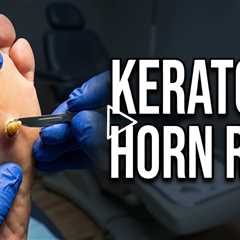 Keratic Horn Removal – Why This Callus Hurts So Much