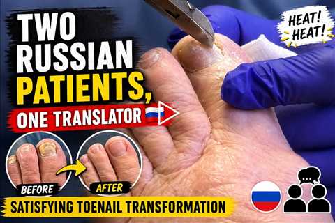 Two Russian Patients, One Translator 🇷🇺 | Satisfying Toenail Transformation