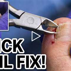 Thick Toenail Causes Hidden Diabetic Foot Wound 😲 | Thick Nail Caused Wound on Toe