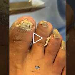 ✂️ Stop Cutting Your Skin! How to Use Nail Nippers Correctly | Dr Nail Nipper