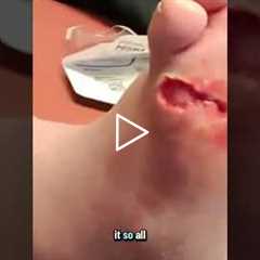 How to Properly Cover a Foot Wound