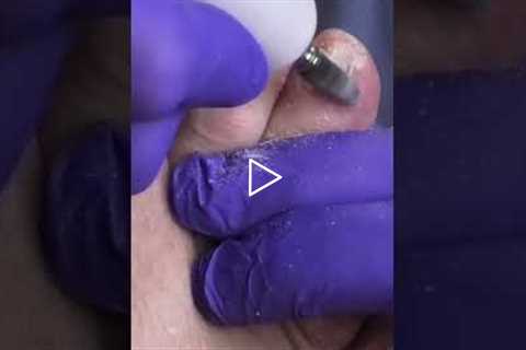 Applying athlete's foot cream can make a big difference in comfort. See the results