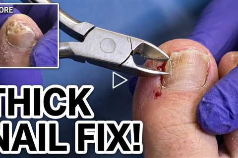 Thick Toenail Causes Hidden Diabetic Foot Wound 😲 | Thick Nail Caused Wound on Toe