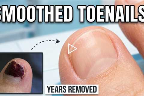 Removing Years of Nail Polish & Smoothing Sensitive Toenails | Podiatry Care