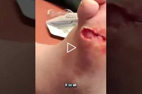 How to Properly Cover a Foot Wound