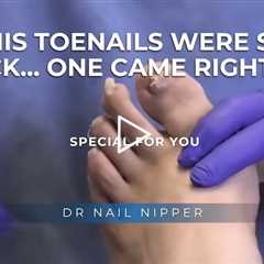 His Toenails Were So Thick… One Came Right Out 😳🦶
