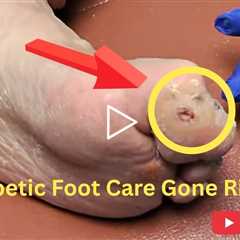 Diabetic Foot Care Gone Right - Here's What Happens | Diabetic Wounds - Part 2