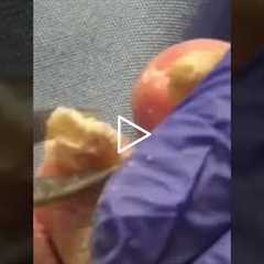Satisfying Nail Removal With a Touching Backstory #healing #emotional