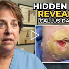 Throwback - Callus or Rock | This Painful Callus Was Hiding an Open Sore! 😳🦶