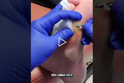 Is This Painful Foot Procedure Worth It